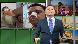 CASTIGO DE DEUS: ADENILSON REIS, QUE FICOU RICO PILHANDO OS COFRES DA PREFEITURA DE NOVA OLINDA DO NORTE, FRATURA O NARIZ QUANDO FAZIA CAMPANHA ANTECIPADA PARA DEPUTADO ESTADUAL. VEJA FOTOS