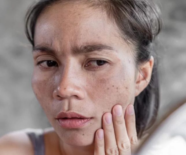 Notícias Melasma E Sol Saiba Como Amenizar As Manchas No Verão Portal Do Zacarias A 7246