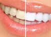 Sorriso amarelo? Entenda o que fazer para manter os dentes brancos