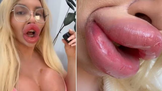 Bizarro Influencer: 'Fiz tanto preenchimento que não consigo respirar direito e fechar a boca'