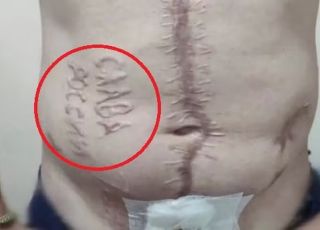 Soldado ucraniano capturado por forças russas tem Glória à Rússia gravada a ferro quente na pele