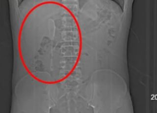 Achou que era um sonho: homem descobre colher no intestino após cinco meses