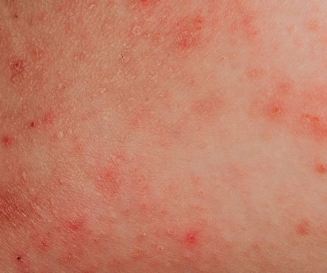 Alergia à água: condição real ou desculpa para não tomar banho?