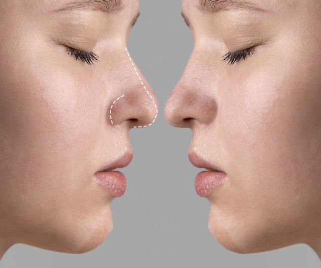  Rinoplastia: estética ou saúde? Entenda quando a cirurgia do nariz é necessária