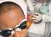 Menino de 10 anos é submetido a remoção de tatuagem após ter palavra chula escrita na testa