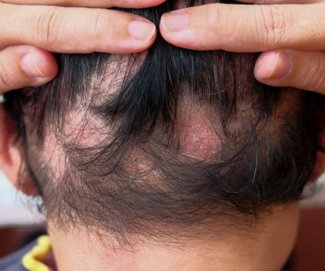 Alopecia areata: conheça a causa e tratamento da condição