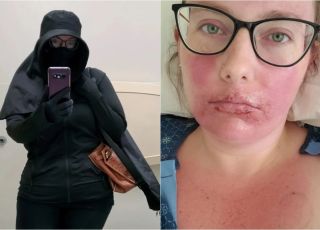 Tenho que viver como uma vampira, diz mulher com alergia ao sol