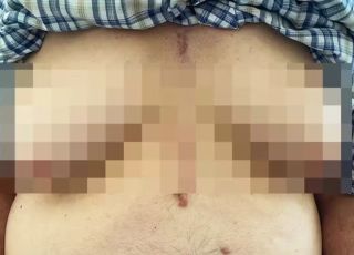 Idoso desenvolve seios após tomar medicamento para condição cardíaca