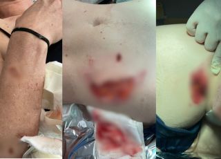 Mulher é mordida por capivara e tem nádegas arrancadas 