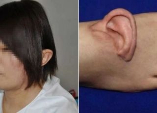 Médicos enxertam orelha em pé de paciente na China