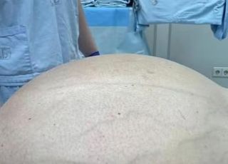 Equipe médica russa retira tumor gorduroso de quase 60 quilos de paciente com 50 anos