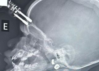 Bebê fica com carregador cravado na testa após cair de cama