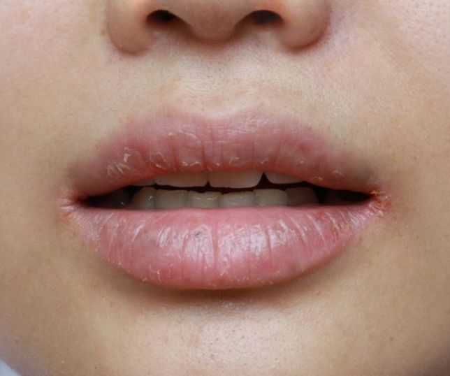 Hábitos simples para evitar lábios ressecados e mantê-los hidratados