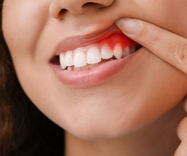 Periodontites ameaçam saúde bucal de milhões de brasileiros