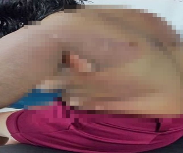 IMAGEM FORTE! Homem inconformado com o fim do relacionamento põe fogo na ex-companheira e no filho em Parintins, interior do Amazonas