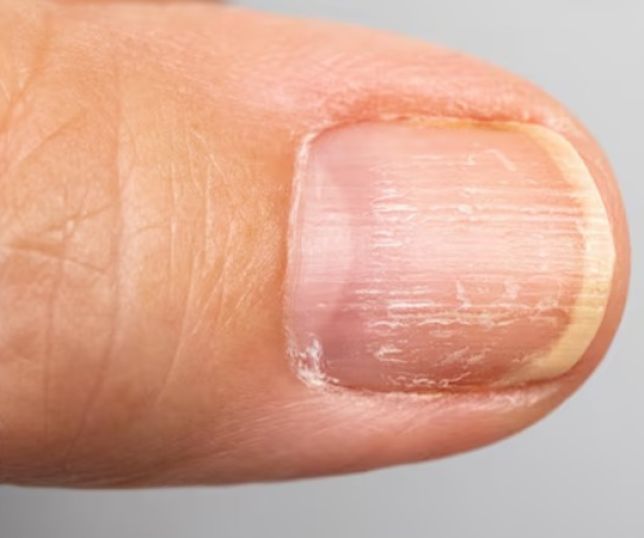  Veja o que diz manicure e saiba o que fazer  após ficar com unha amarelada depois de usar esmalte