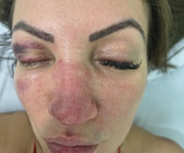 Vereadora relata agressão do namorado e o atropela ao tentar fugir em Embu das Artes. VEJA VIDEO