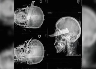 Mulher tem faca cravada no olho em tentativa de feminicídio em Santa Catarina