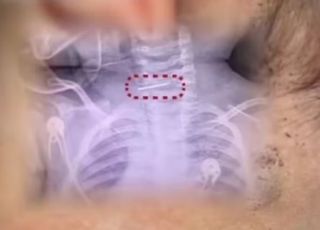 Bebê chinês é hospitalizado após mãe cravar até 600 vezes agulhas no corpo como remédio