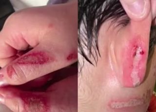 Desafio do TikTok deixa menino de 9 anos gravemente queimado nos EUA