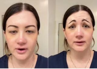 Botox de R$ 2.700 dá errado e mulher fica com cara de ''palhaço triste''