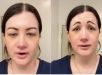 Botox de R$ 2.700 dá errado e mulher fica com cara de ''palhaço triste''