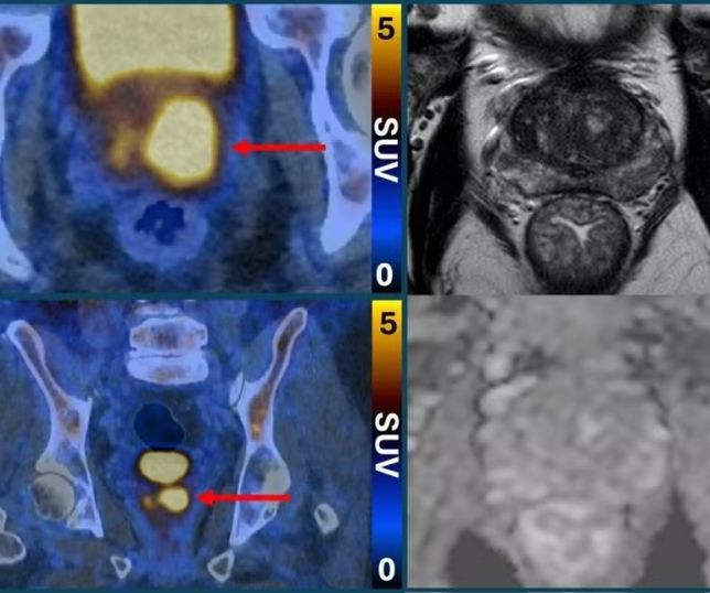 Novo exame de imagem pode reduzir biópsias e melhorar detecção do câncer de próstata