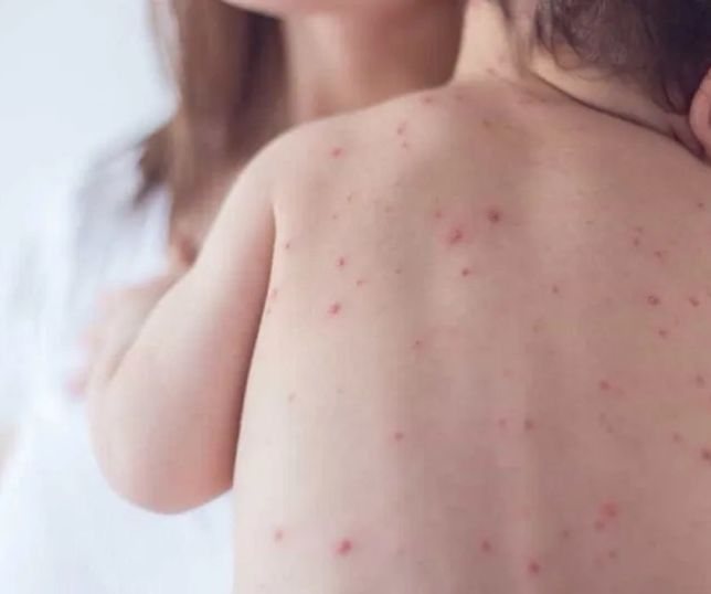Caso confirmado de sarampo acende alerta sobre cobertura vacinal
