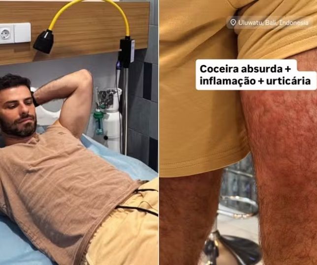 Ator Lucas Malvacini é atacado por ácaros em restaurante na Indonésia e precisa de hospitalização