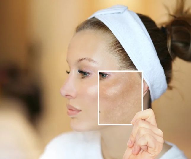 Secador pode piorar melasma e calor no rosto vira vilão silencioso da pele