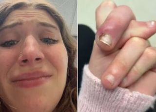 Jovem quase perde dedo após infecção grave causada pelo hábito de roer unhas