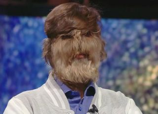 Homem com síndrome do lobisomem vira fenômeno na internet