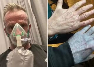 Homem procura hospital após notar pele azul e descobre causa inusitada