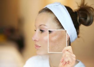 Secador pode piorar melasma e calor no rosto vira vilão silencioso da pele