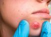 Dermatologista explica como prevenir e tratar furúnculos de forma correta