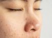 Por que os cravos do nariz são tão difíceis de eliminar? Dermatologista explica