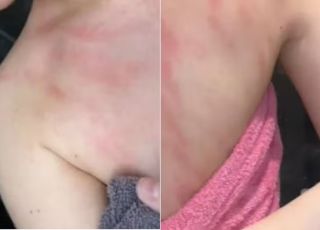 Mulher alérgica à água diz sentir dores intensas ao tomar banho; entenda o problema