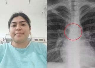 Mulher descobre que piercing de nariz perdido estava alojado no pulmão