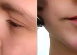 ''Piercing de espinhas'': nova tendência estética viraliza e divide opiniões nas redes sociais 