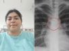 Mulher descobre que piercing de nariz perdido estava alojado no pulmão