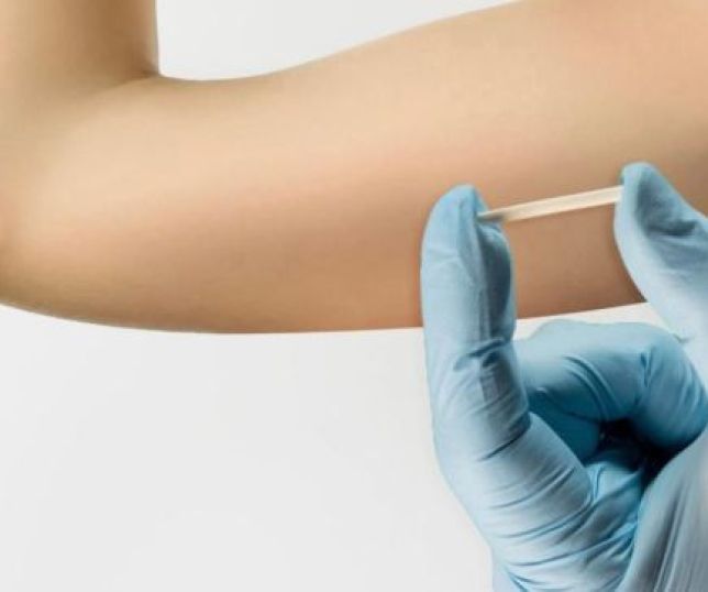 Implantes hormonais exigem cautela em mulheres com lipedema e podem agravar riscos à saúde