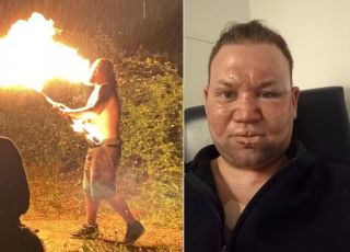 Cuspidor de fogo amador sofre grave acidente em churrasco e fica com rosto queimado