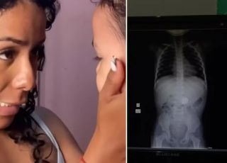 Mãe se assusta após filha revelar que engoliu uma moeda e raio-X confirmar objeto