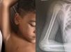 Menino de 6 anos descobre câncer raro após fortes dores no braço e passa por tratamento