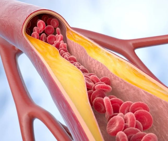 Reduzir o colesterol LDL é fundamental para proteger o coração e evitar doenças graves