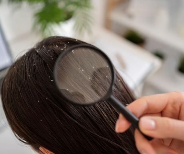Frio e ar seco aumentam os casos de caspa durante o inverno, alerta dermatologista