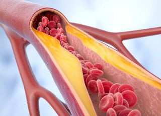 Reduzir o colesterol LDL é fundamental para proteger o coração e evitar doenças graves