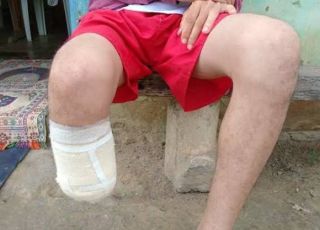 Homem amputa o próprio pé para receber seguro de R$ 1,5 milhão e é condenado na Bahia