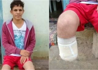 Servidor público da Bahia que amputou o próprio pé para tentar receber R$ 1,5 milhão teve membro encontrado dentro da mochila