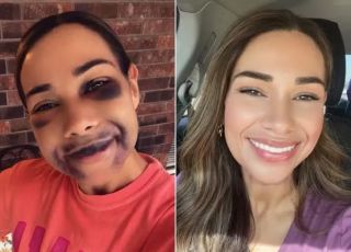 Mulher aparece com rosto marcado por hematomas após implantes dentários e chama atenção nas redes